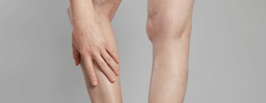 Varicose Vein Treatments