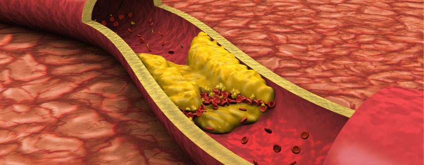 Peripheral Arterial Disease (PAD)